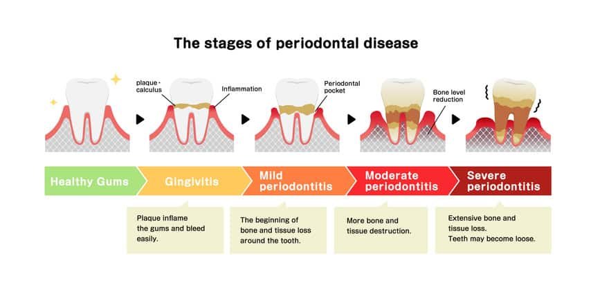 Boston Painless Gum Disease Treatment