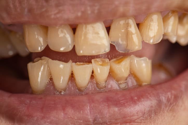 teeth straightening