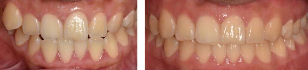crooked teeth painless treatment in treatment