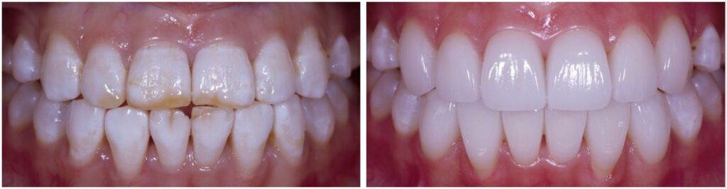 Veneers teeth whitening