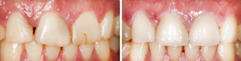 Veneer dentist downtown