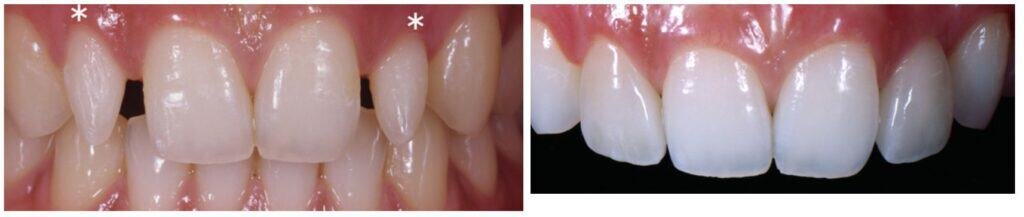 Boston Veneer dentist